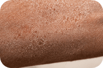 understanding your skin type - dry skin